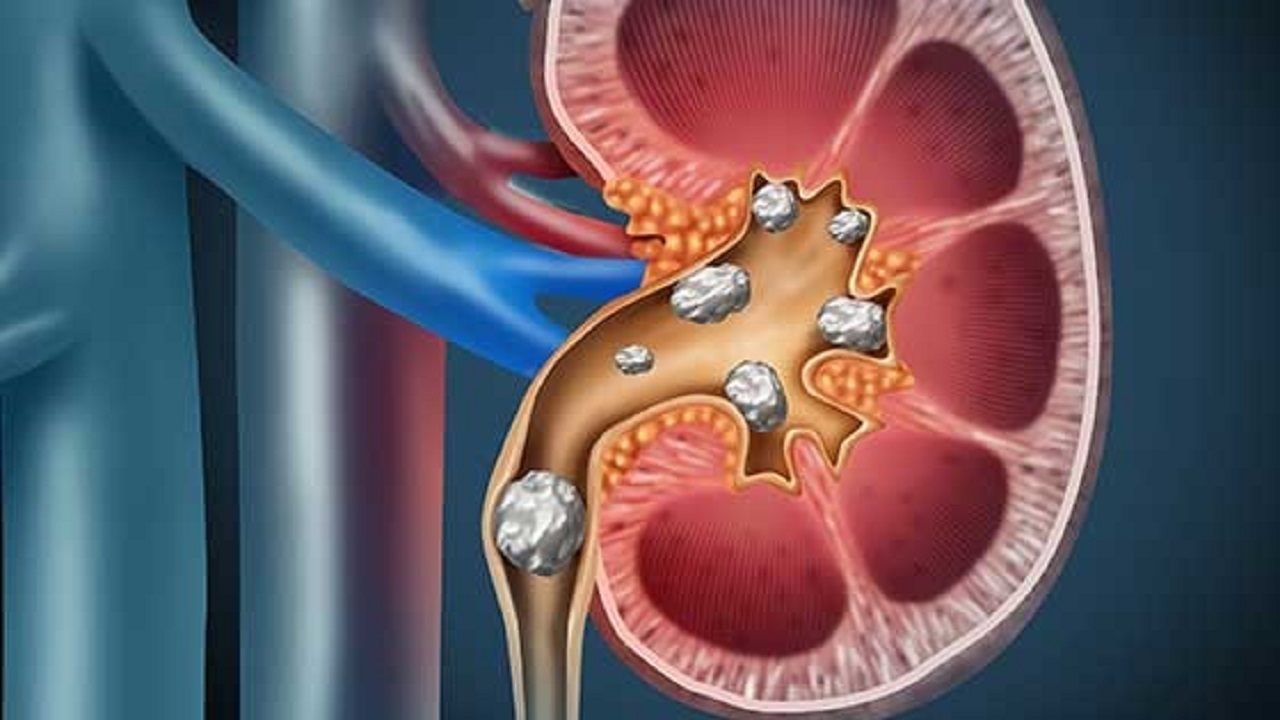 علت سنگ ساز شدن کلیه‌ها چیست؟ + فیلم