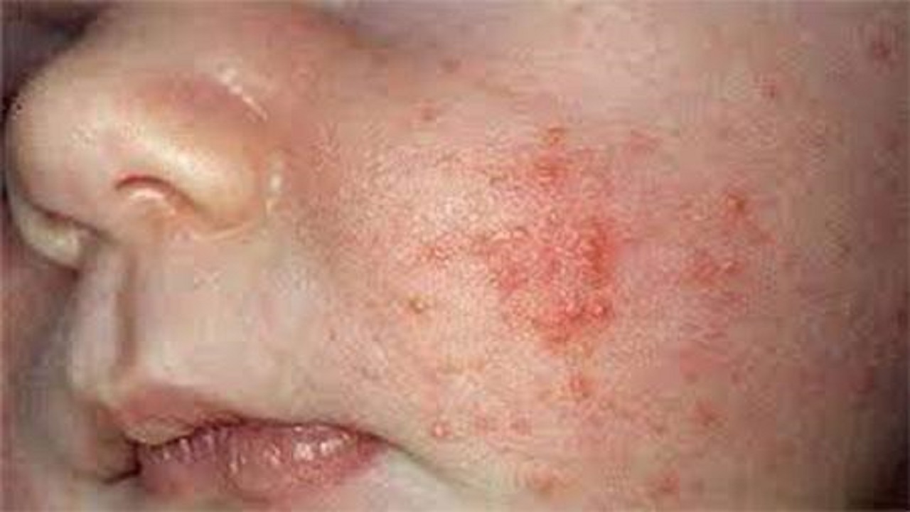 شناسایی یک کودک مبتلا به سرخک در استان قزوین