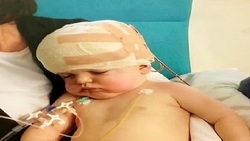 باشگاه خبرنگاران -نجات یک کودک با بازسازی جمجمه اش