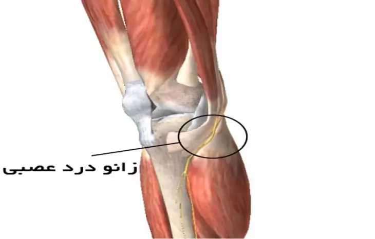 زانودرد عصبی
