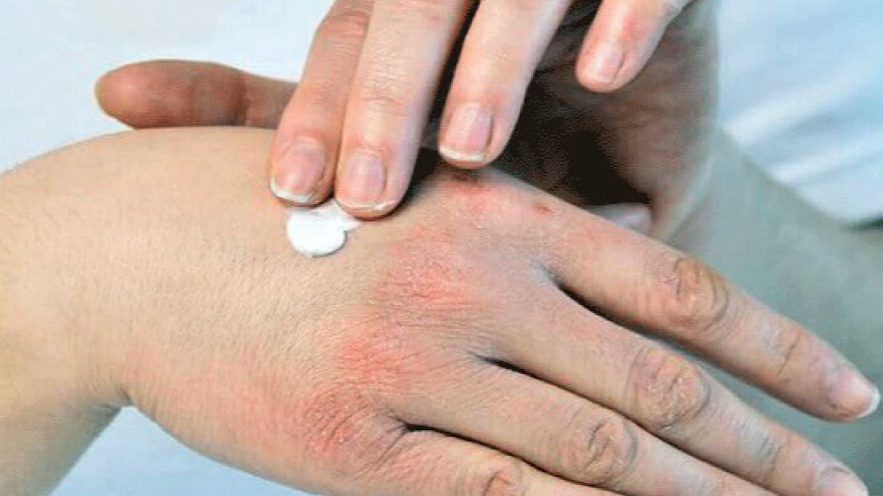 اثرات هوای سرد بر روی پوست