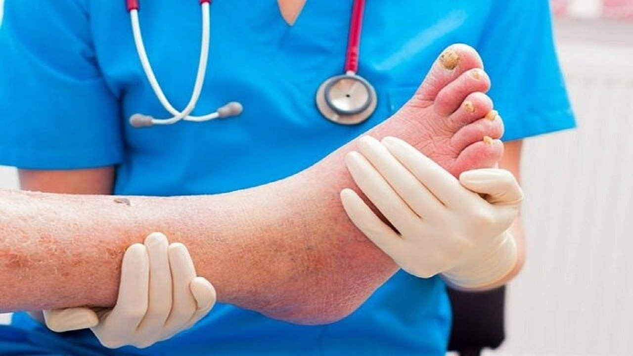 چگونگی پیشگیری از عارضه پای دیابتی