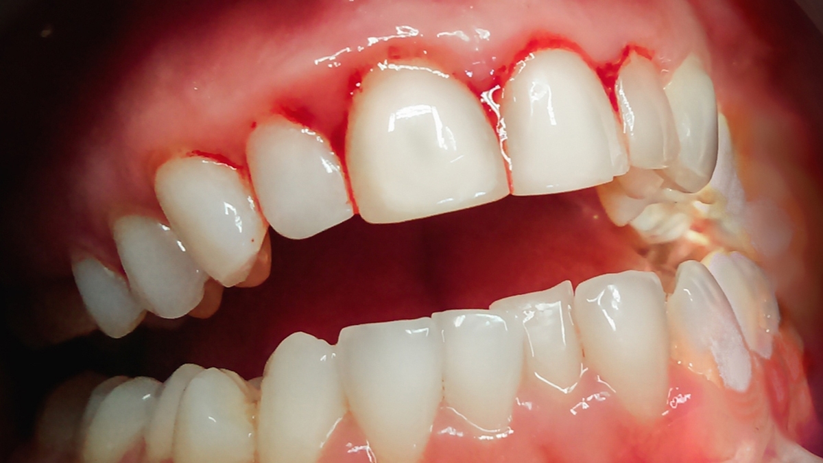 راه حل رفع تیرگی زیر چشم + فیلم