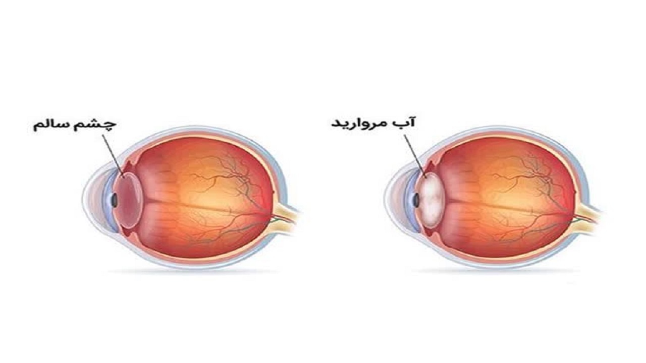 مرواریدی که برای چشم دردسرساز می‌شود