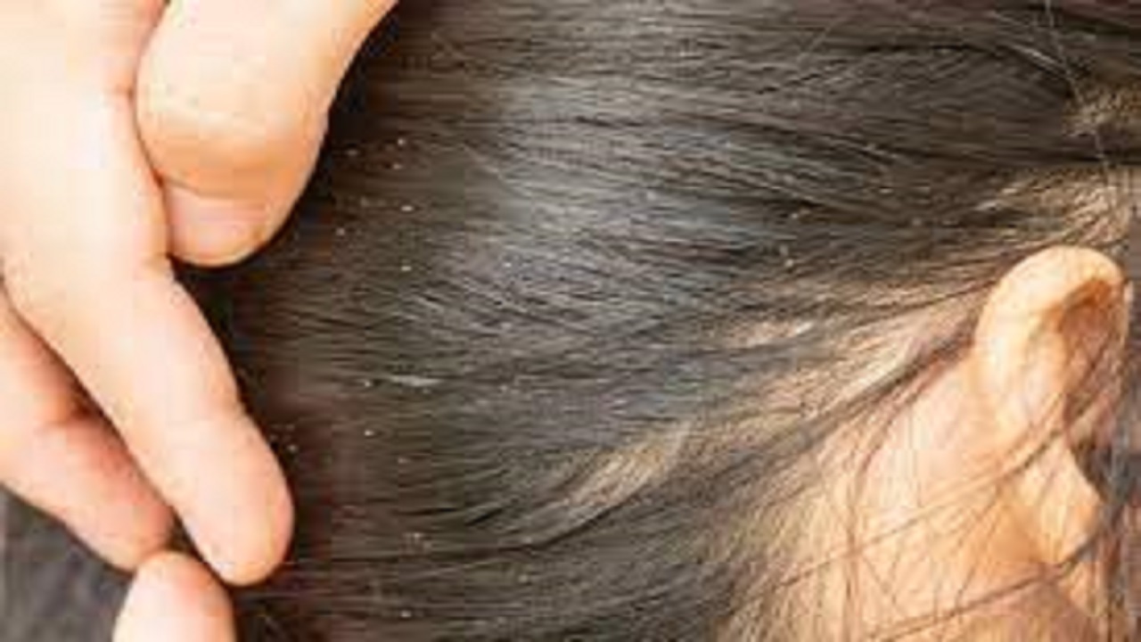 شپش سر