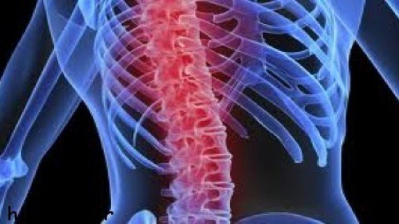 تحریک طناب نخاعی در کاهش نوروپاتی دیابتی موثر است