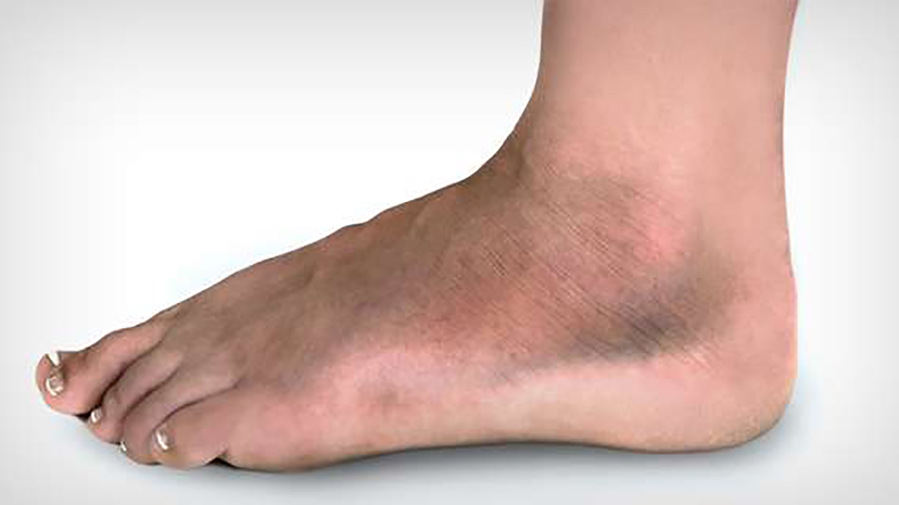 آمبولی به چه معناست؟ + فیلم