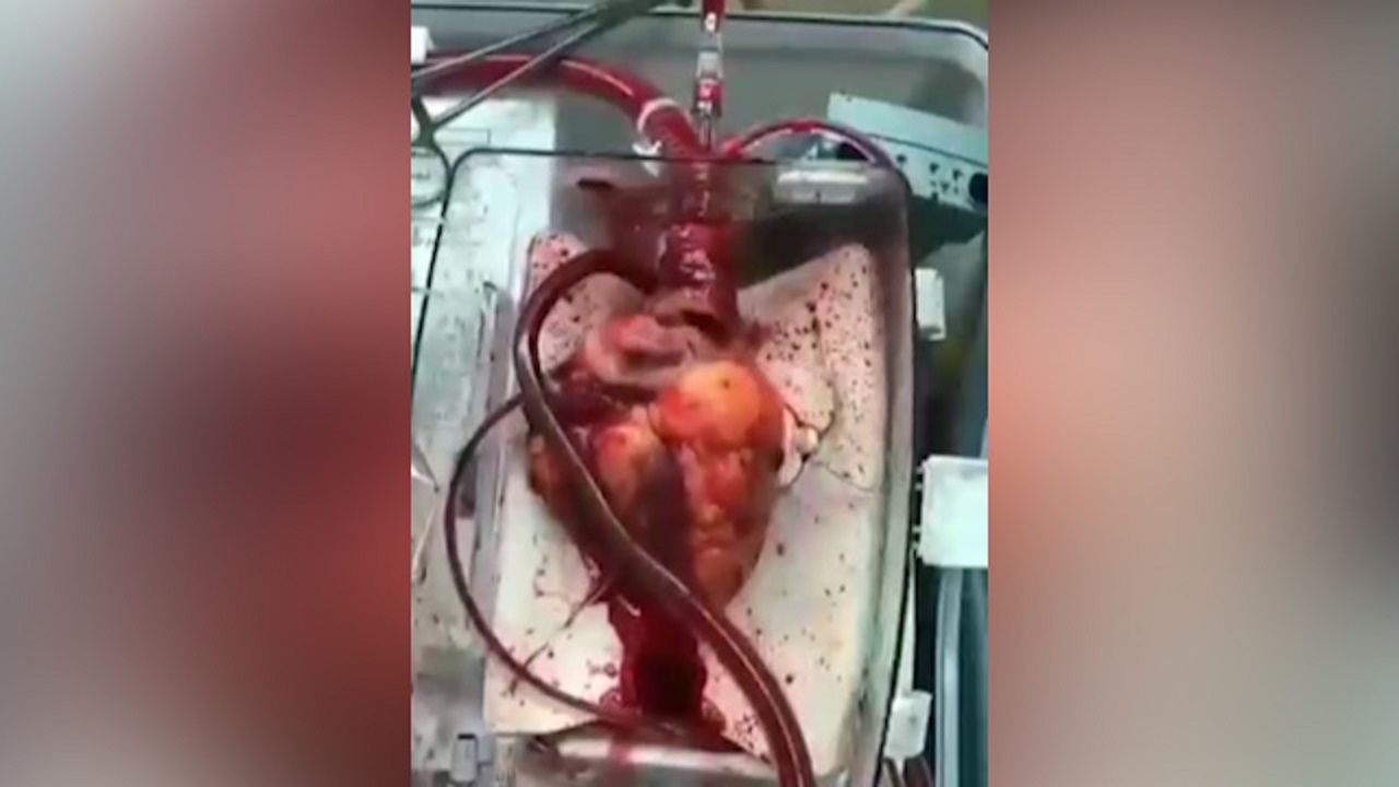 جعبه نگهداری قلب آماده پیوند + فیلم