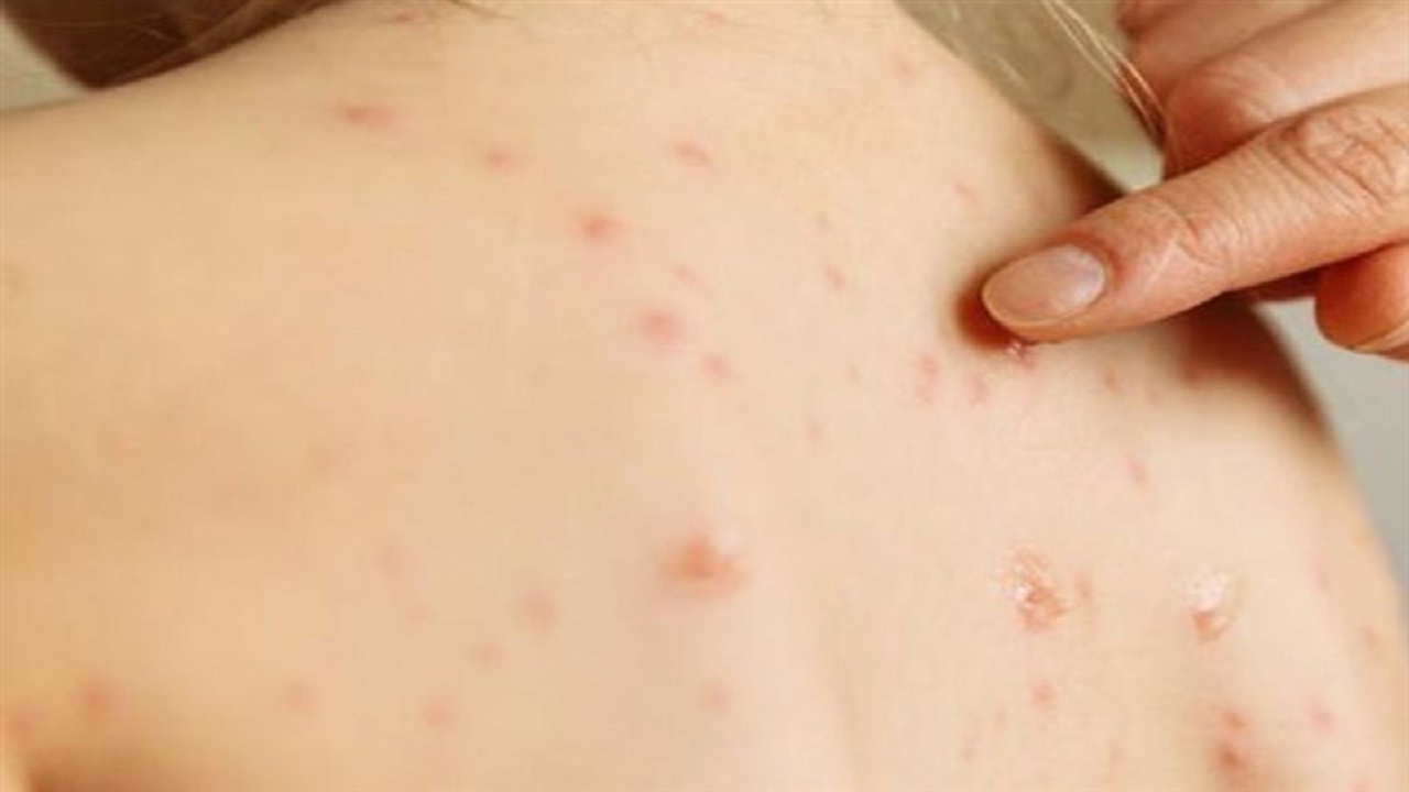 موردی از سرخک در اصفهان مشاهده نشده است