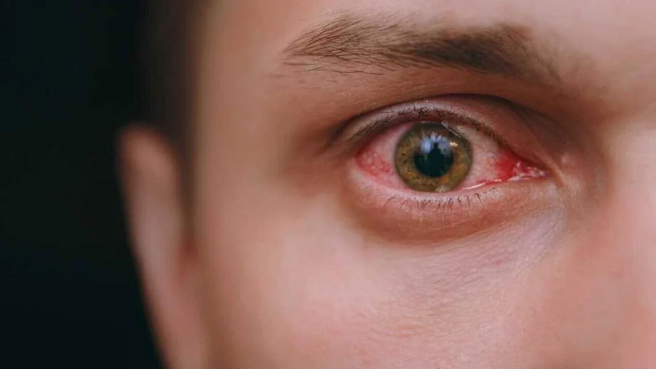 نکاتی در خصوص حساسیت و عفونت چشم + فیلم