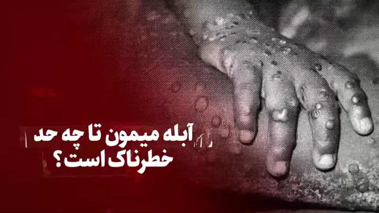 آبله میمون تا چه حد خطرناک است؟ + فیلم