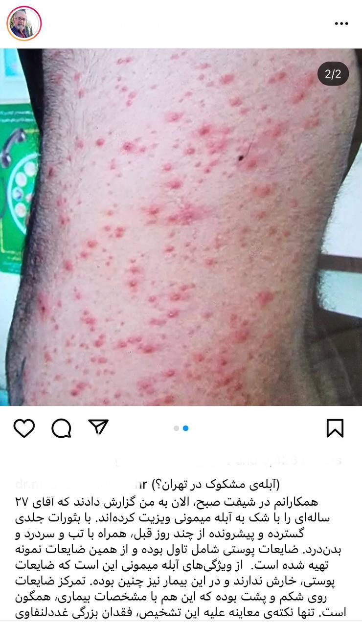 شناسایی آبله میمونی در تهران صحت ندارد