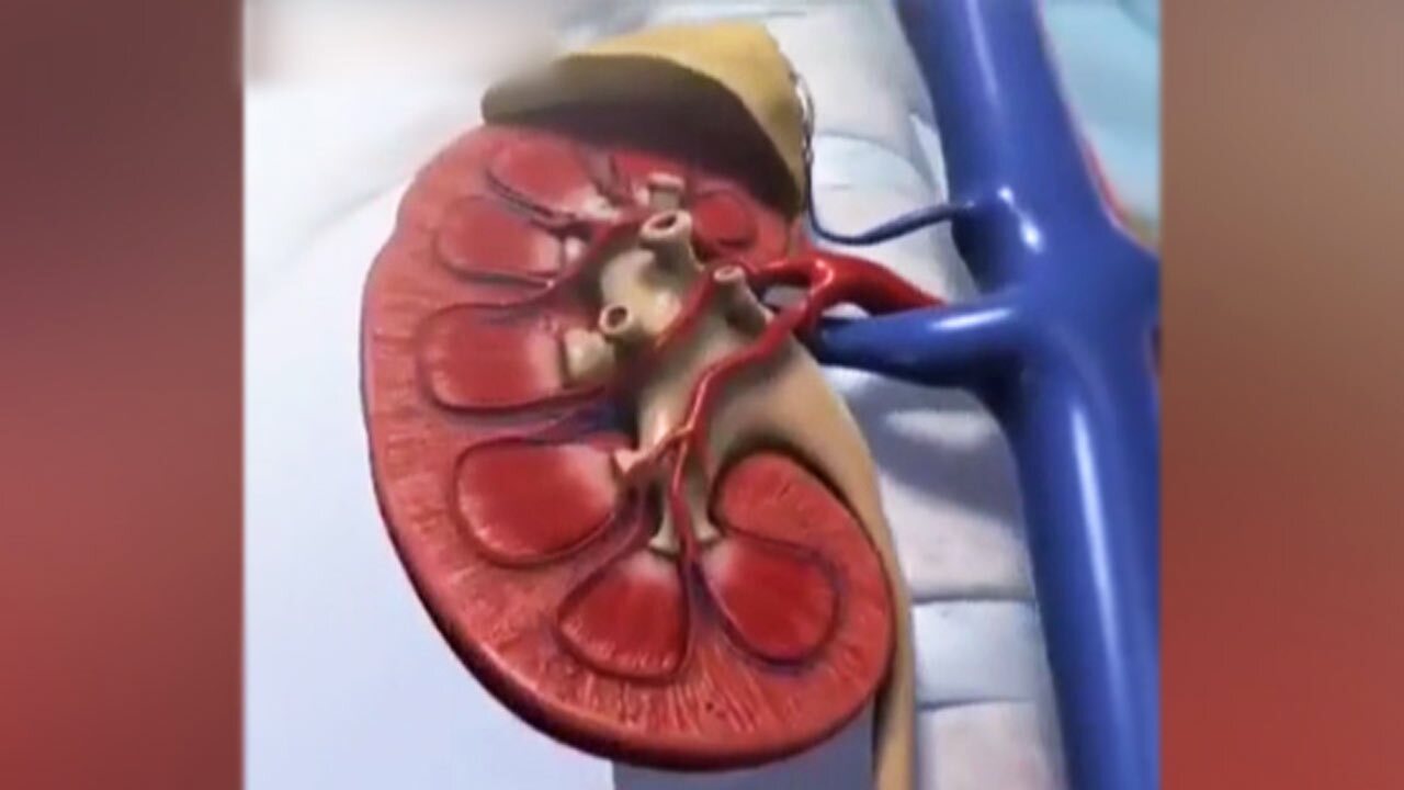 فیلمی از لحظه تشکیل سنگ کلیه