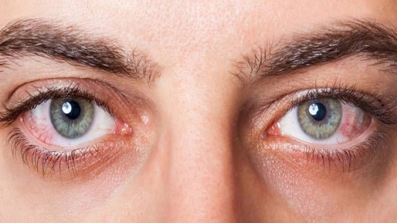 افزایش ریسک ابتلا به آب مروارید با تغییرات در ژن کاهنده