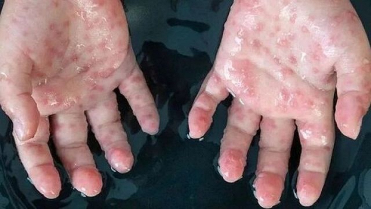 هیچ مورد مشکوک و مثبتی از ابتلای دام‌های همدان به آبله میمونی گزارش نشده است