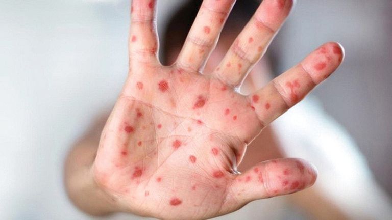 /////// ۱۰پرسش و پاسخ مهم در مورد بیماری آبله میمون