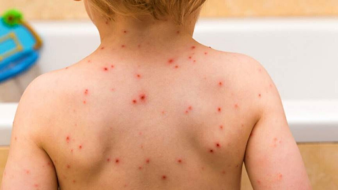 چهار هزار کودک در بدخشان به سرخک مبتلا شده اند