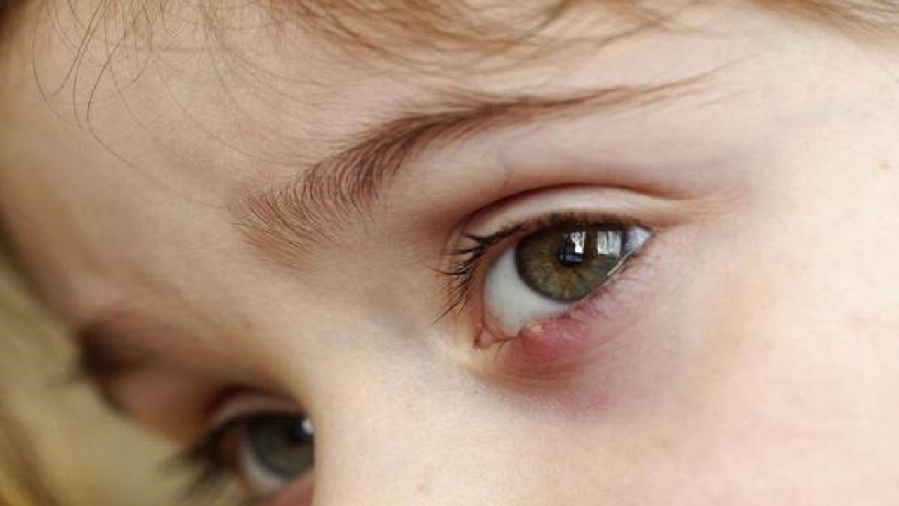 دلایل التهاب و خارش چشم + فیلم