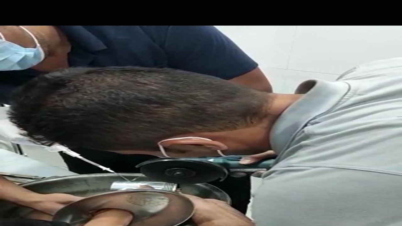 چرخ گوشت، انگشتان دختربچه ٢ ساله را بلعید