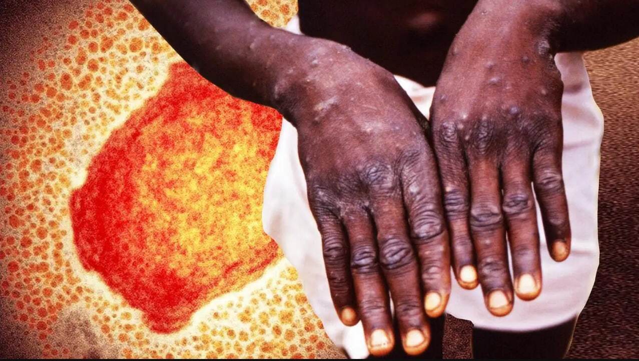 ثبت اولین موارد ابتلا به آبله میمون کودکان در آمریکا