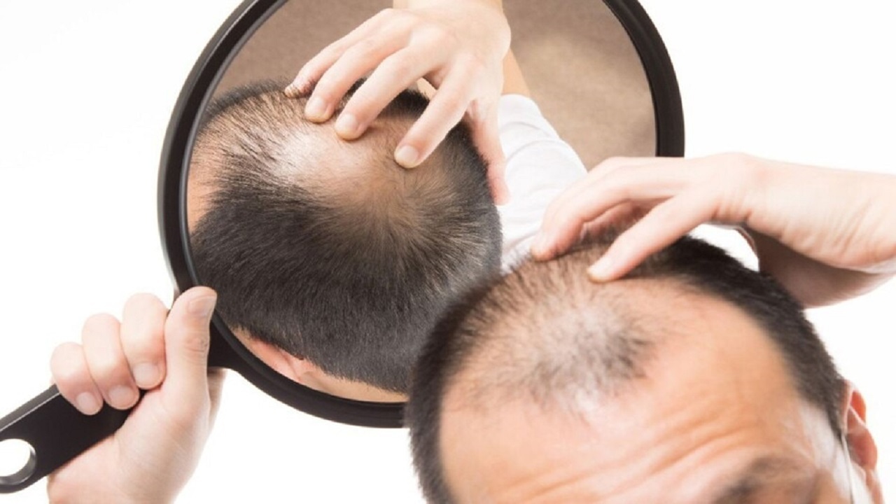 آیا به زودی با طاسی خداحافظی خواهیم کرد؟