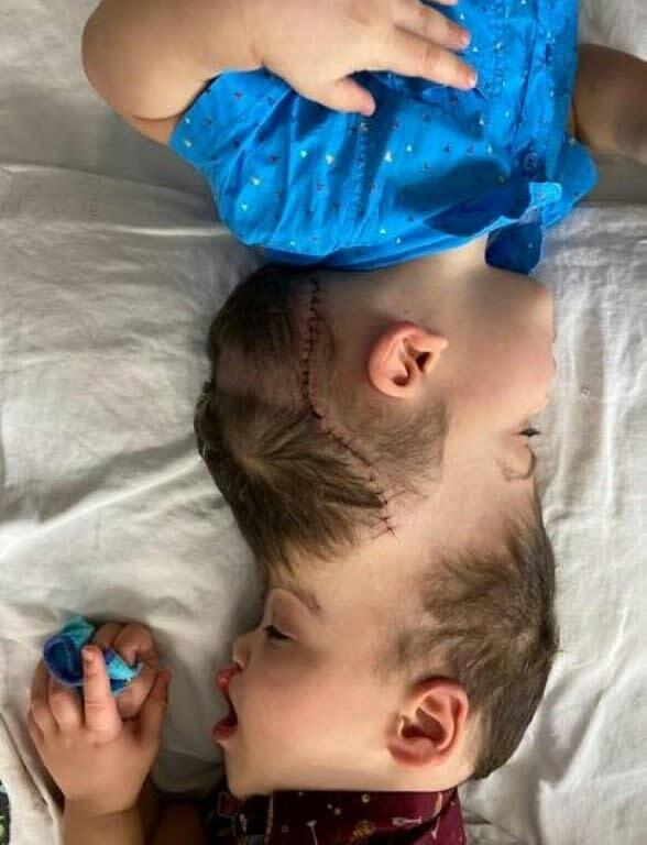 دوقلو های به هم چسبیده