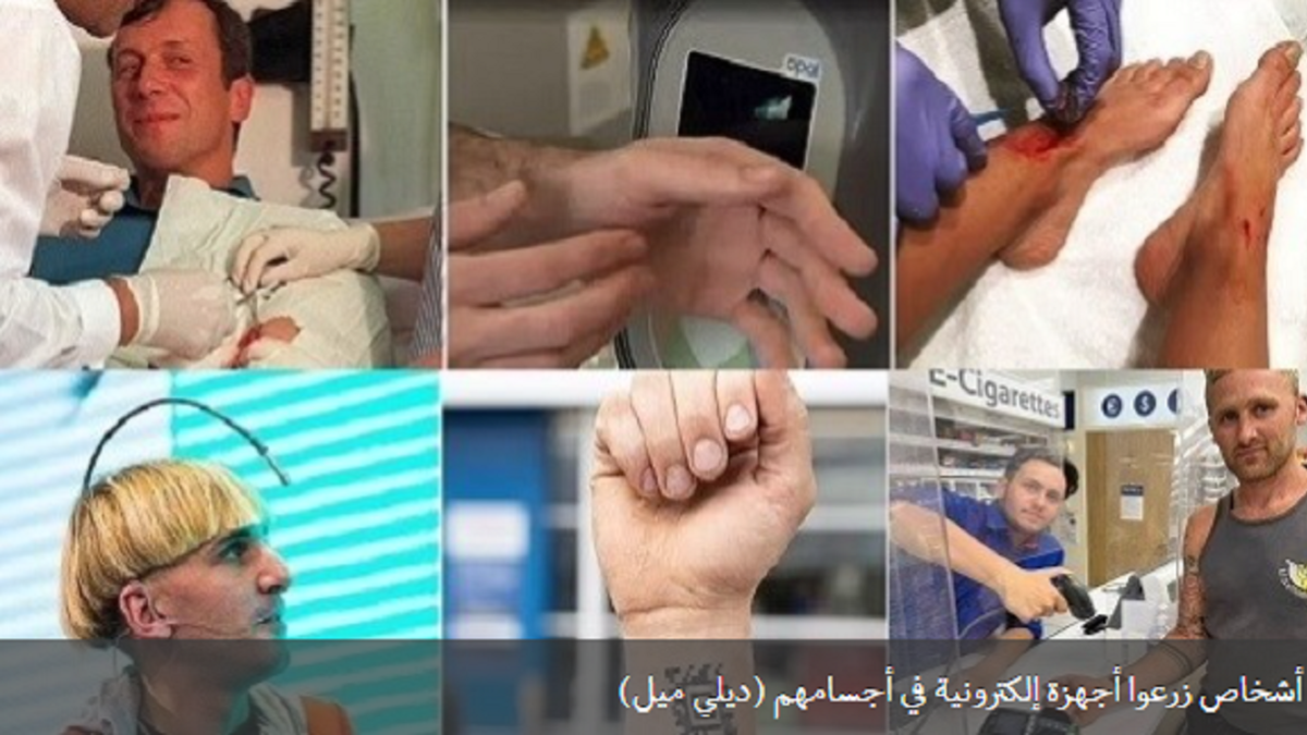 باشگاه خبرنگاران -عجیب ترین موارد کاشت وسایل الکترونیکی در بدن انسان