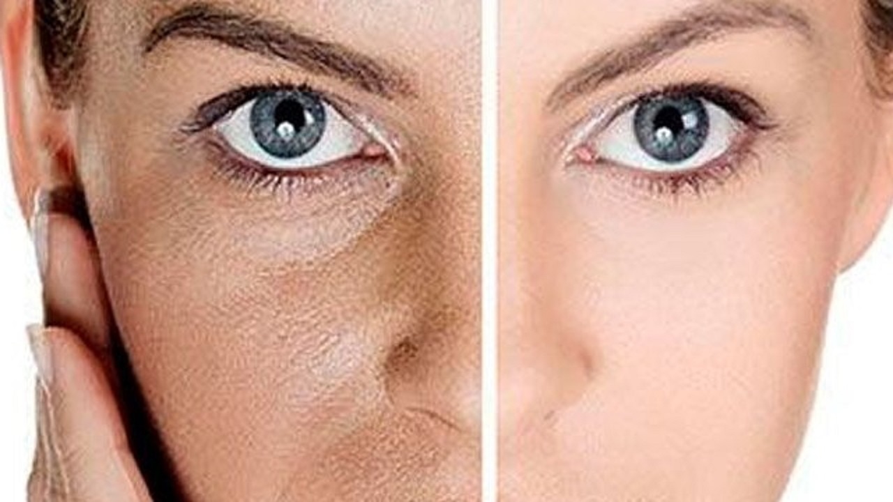 راهکاری برای رفع لکه‌های صورت + فیلم