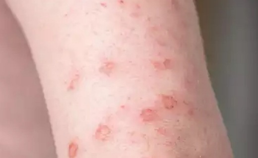 آبله میمونی