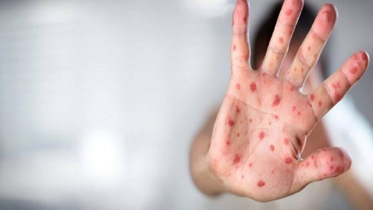 آبله میمونی چه علائمی دارد؟