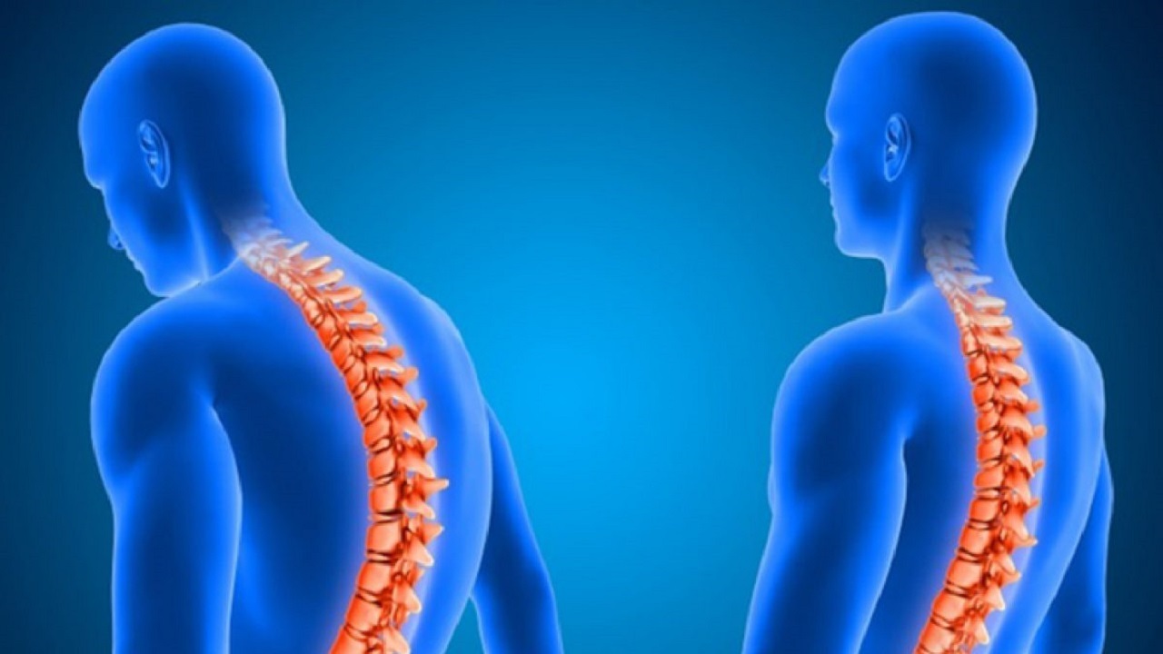 درمان گوژپشتی در جوانان و نوجوانان و تمرينات اصلاحی + فیلم
