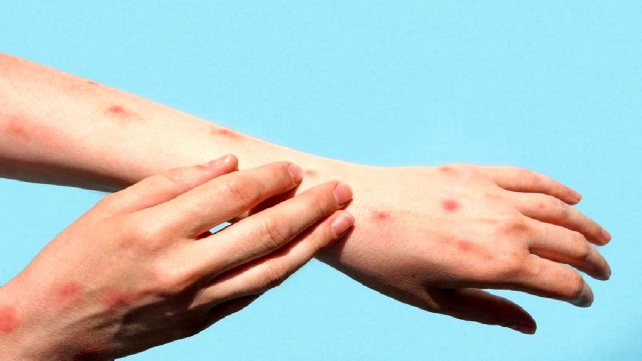 منتظر جواب آزمایش فرد مشکوک به آبله میمون هستیم