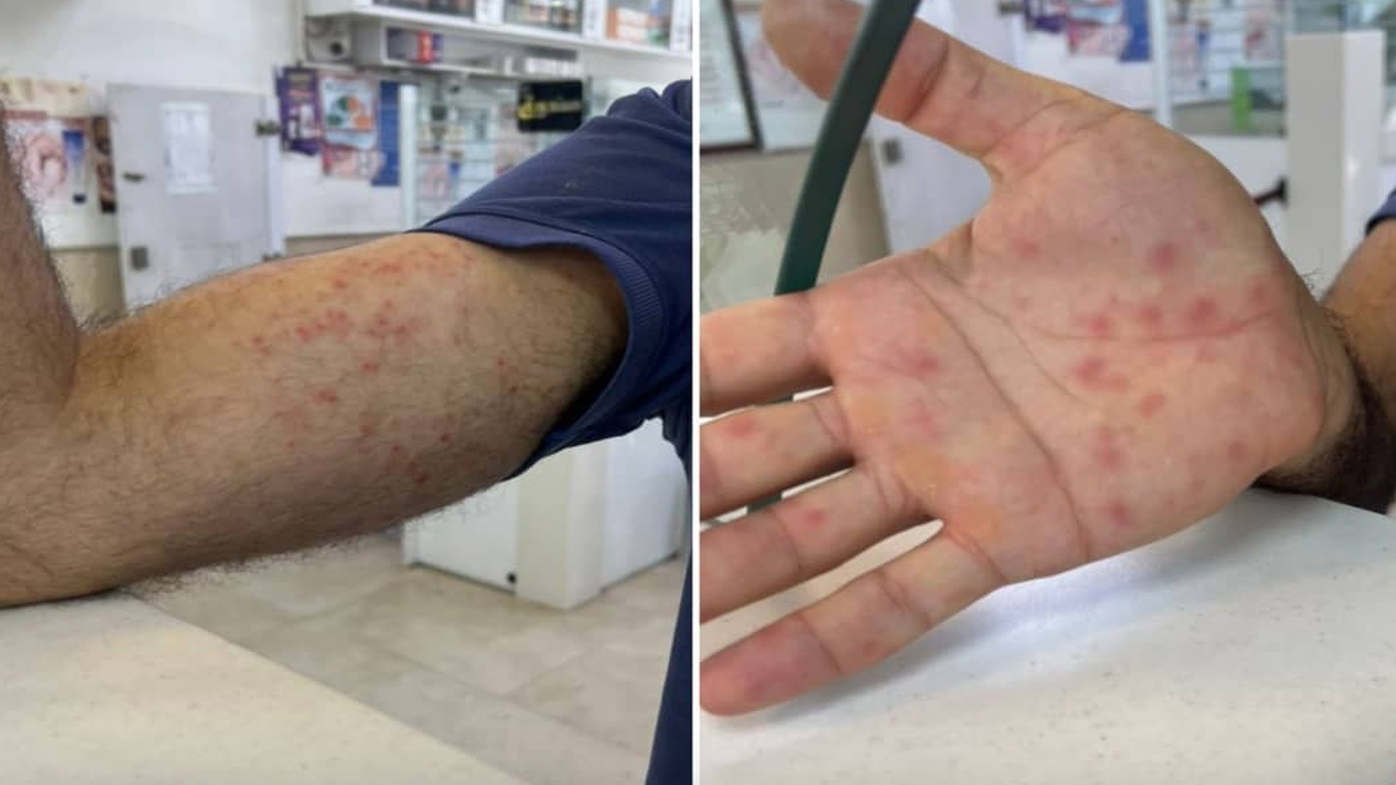 جواب آزمایش فرد مشکوک به آبله میمونی در بابل منفی شد