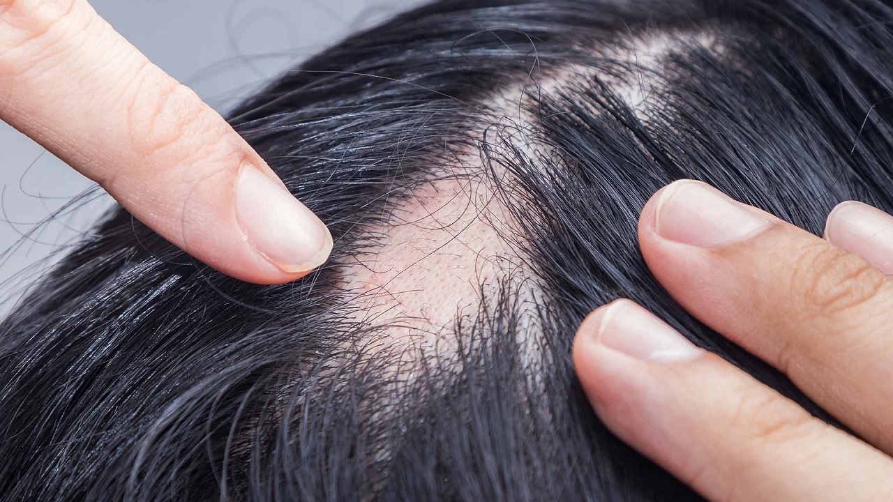همه چیز درمورد ریزش موی سکه ای + فیلم