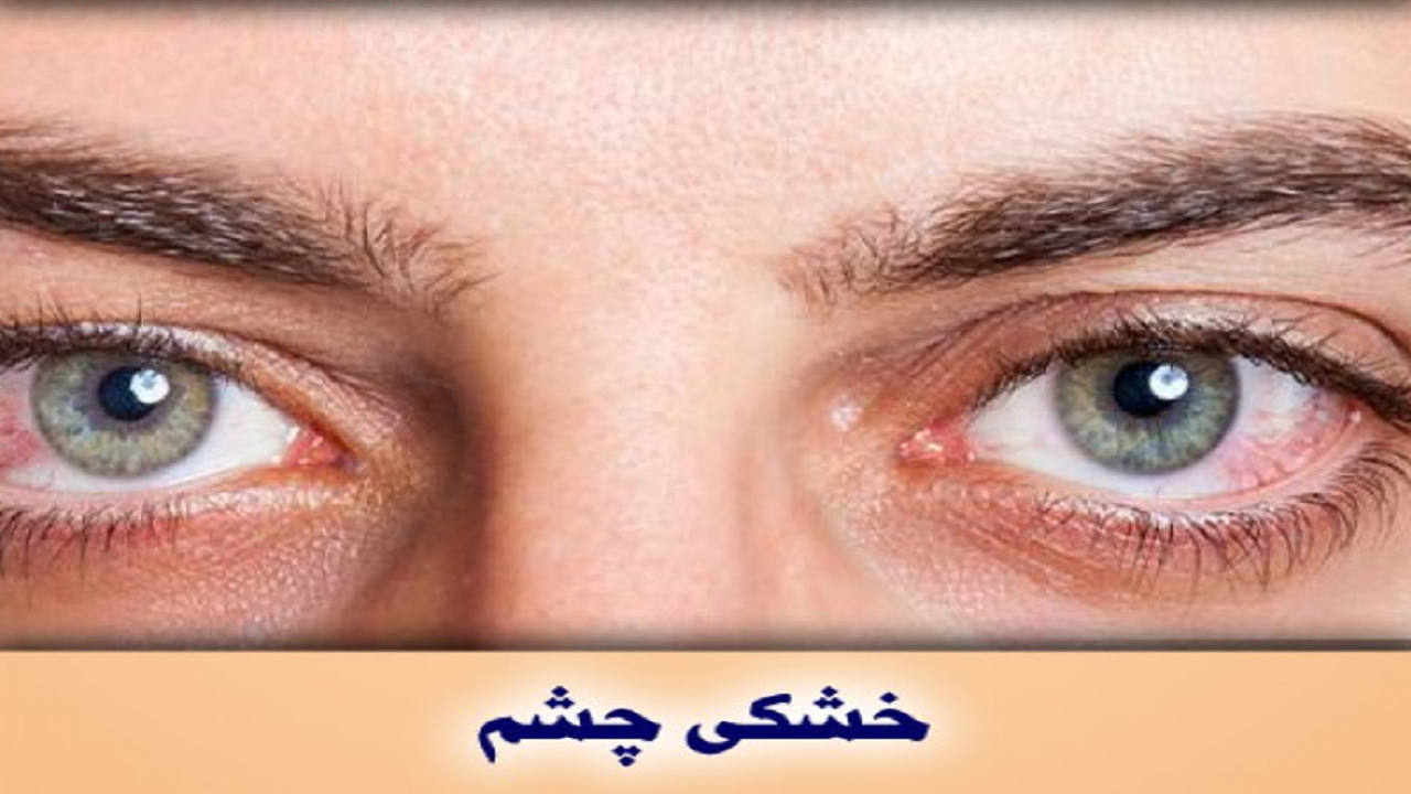 بررسی اثربخشی درمان خشکی چشم با استفاده از پالس نوری شدید