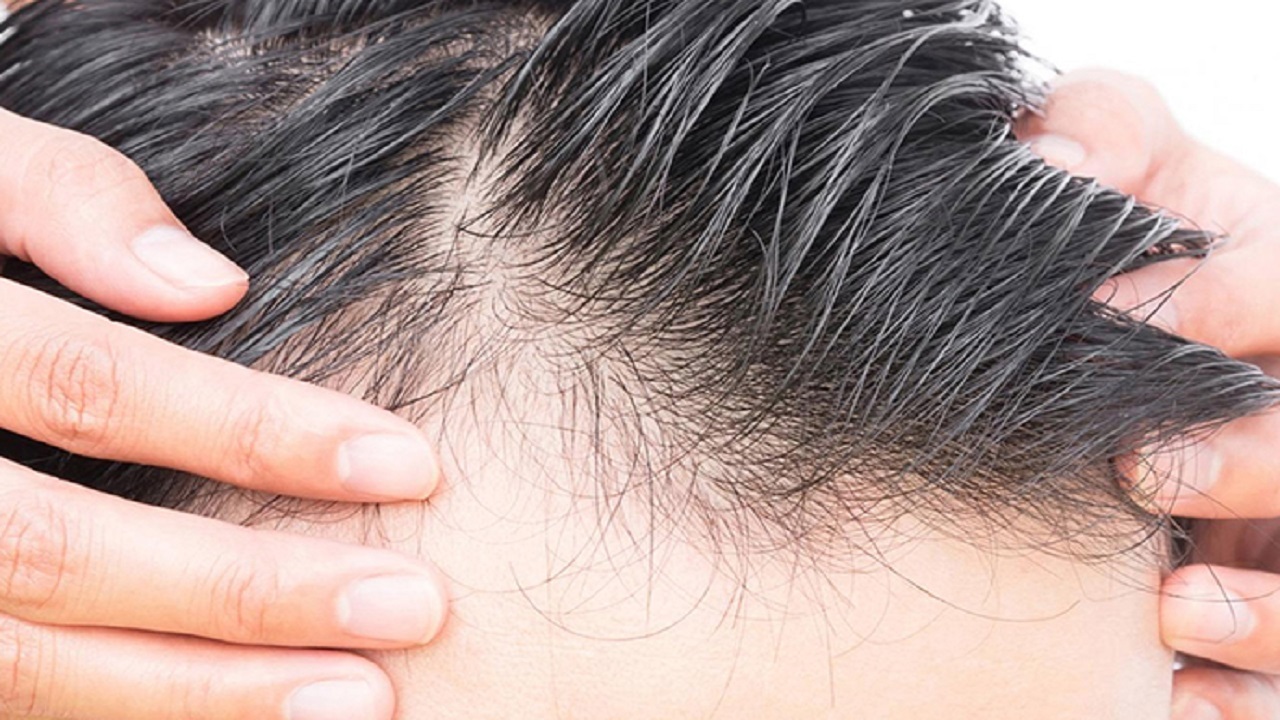 برای اینکه ریزش مو نگیرید این ۵ ماده غذایی را کمتر بخورید