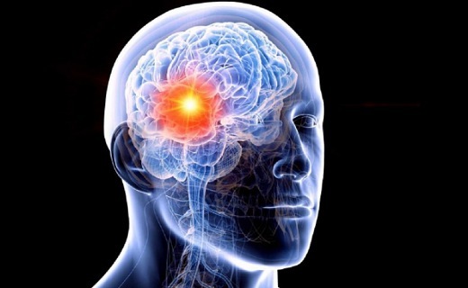 تومور مغزی