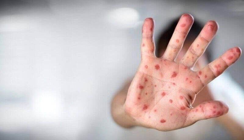 آبله میمون می تواند موجب بروز التهاب مغزی شود