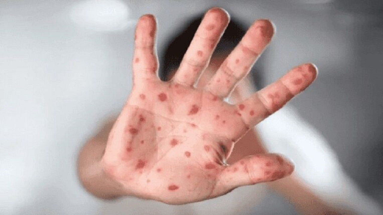 ️ابتلای نزدیک به ۲۰ هزار نفر در اتحادیه اروپا به آبله میمون