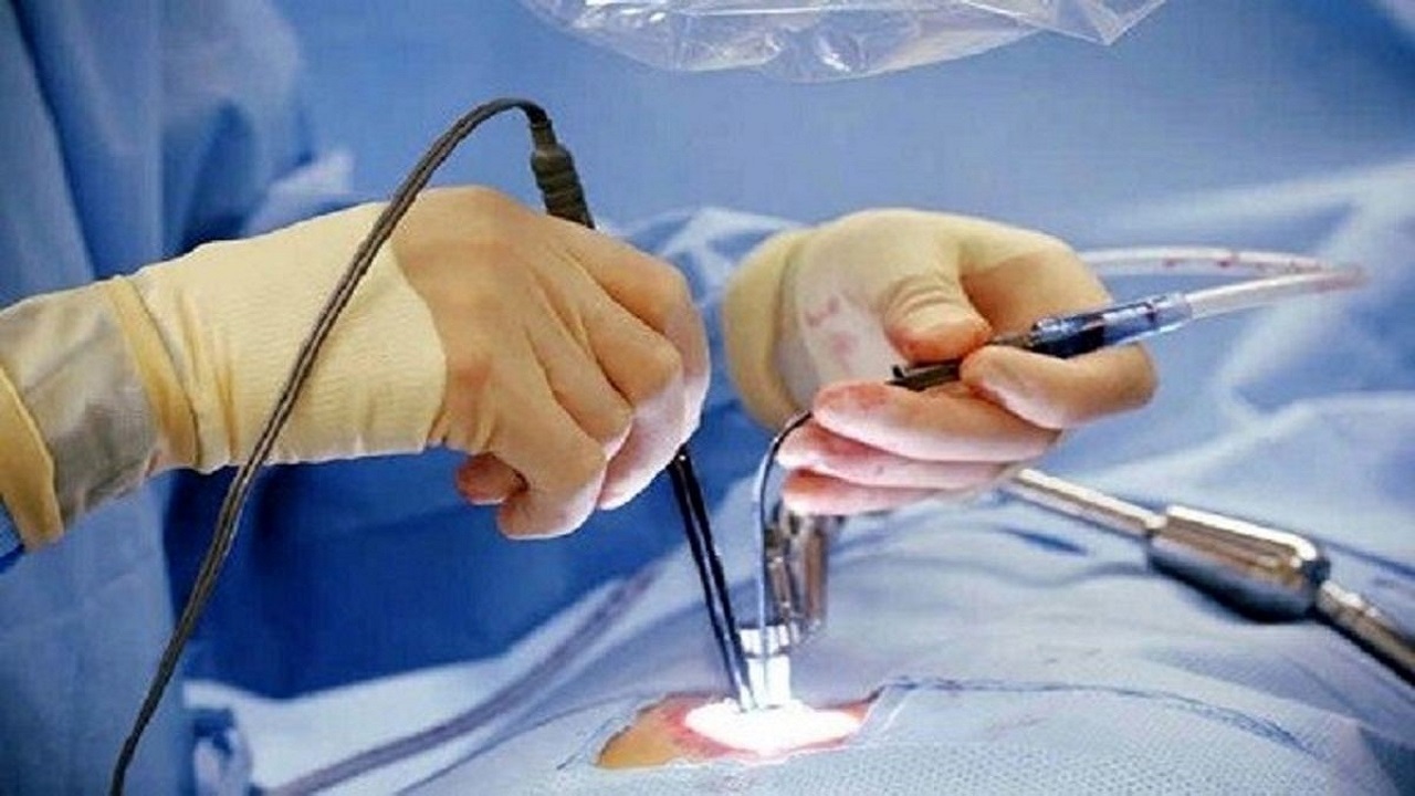 انجام اولین عمل جراحی روده بزرگ به روش مدرن لاپارسکوپی