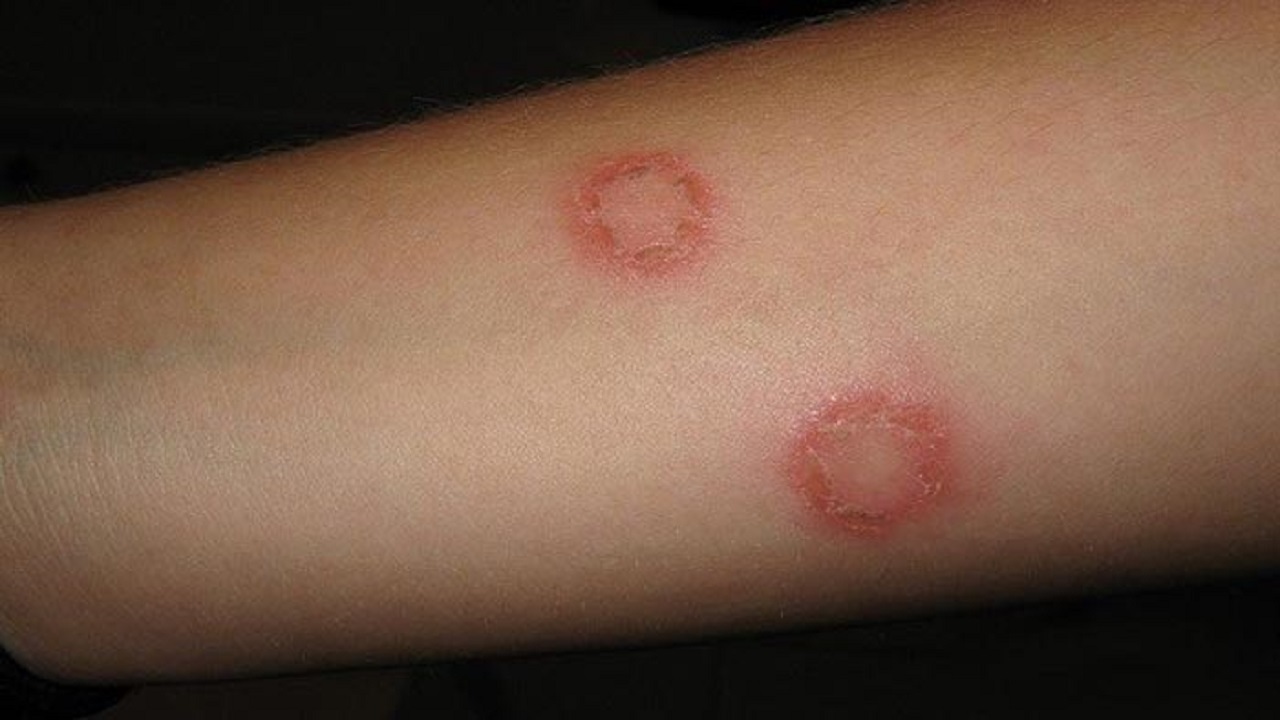 فارس و اصفهان بیشتر موارد شناسایی شده بیماری سالک را دارند