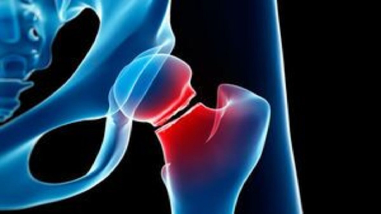 ضرورت توجه و پیشگیری به موقع از ابتلا به پوکی استخوان
