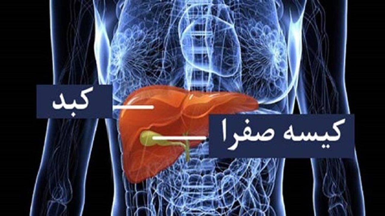 وجود سنگ‌، شایع‌ترین مشکل کیسه صفرا