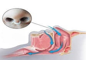 آیا احتمال تو دماغی شدن صدا پس از عمل جراحی بینی وجود دارد؟