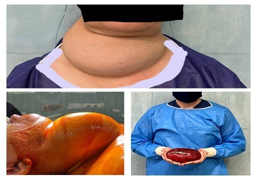 تیروئید دوکیلویی از گلوی یک بیمار در کرج خارج شد+تصویر