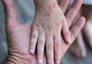 کاهش تمایل به خوردن به دلیل وجود ضایعات در دهان کودک در بیماری دست، پا و دهان