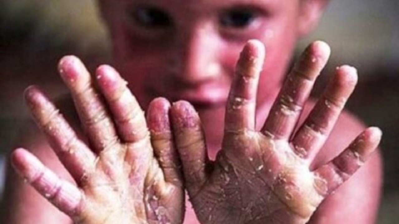 درخواست کودک پروانه‌ای از وزیر امور خارجه + فیلم
