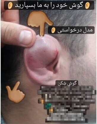 گوش شکسته