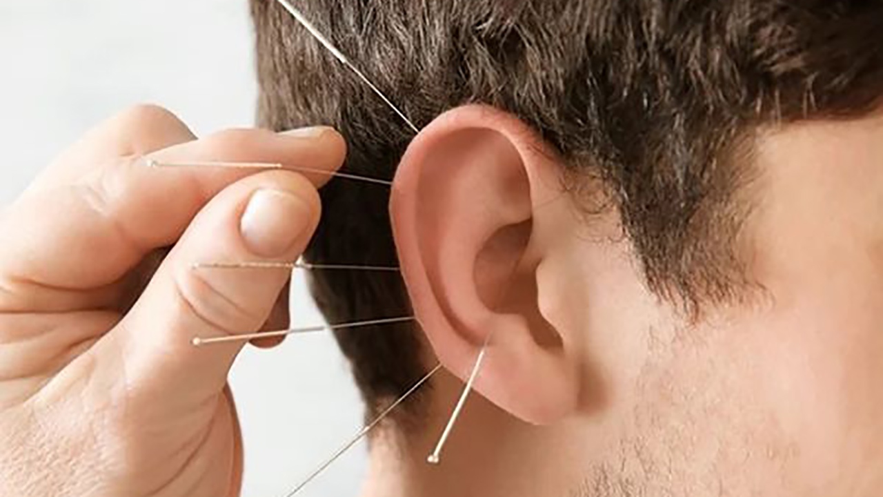 اثرات طب سوزنی در جوان سازی پوست + فیلم