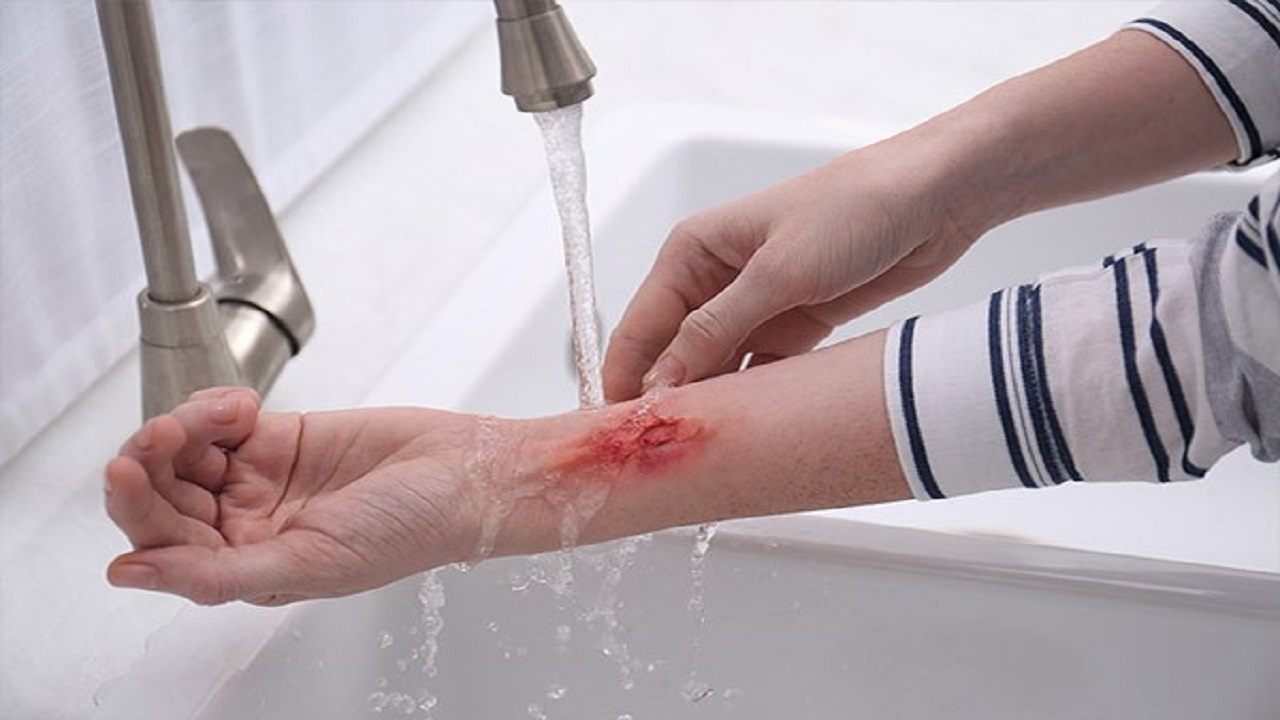 اقدامات اولیه هنگام سوختگی + فیلم
